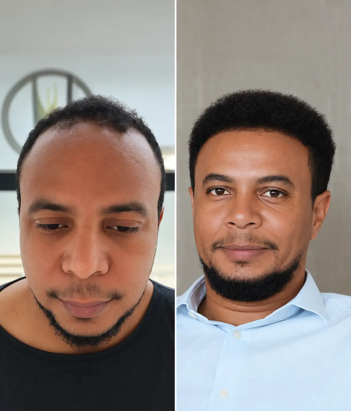 Real patient before and after hair transplant growth in Nairobi