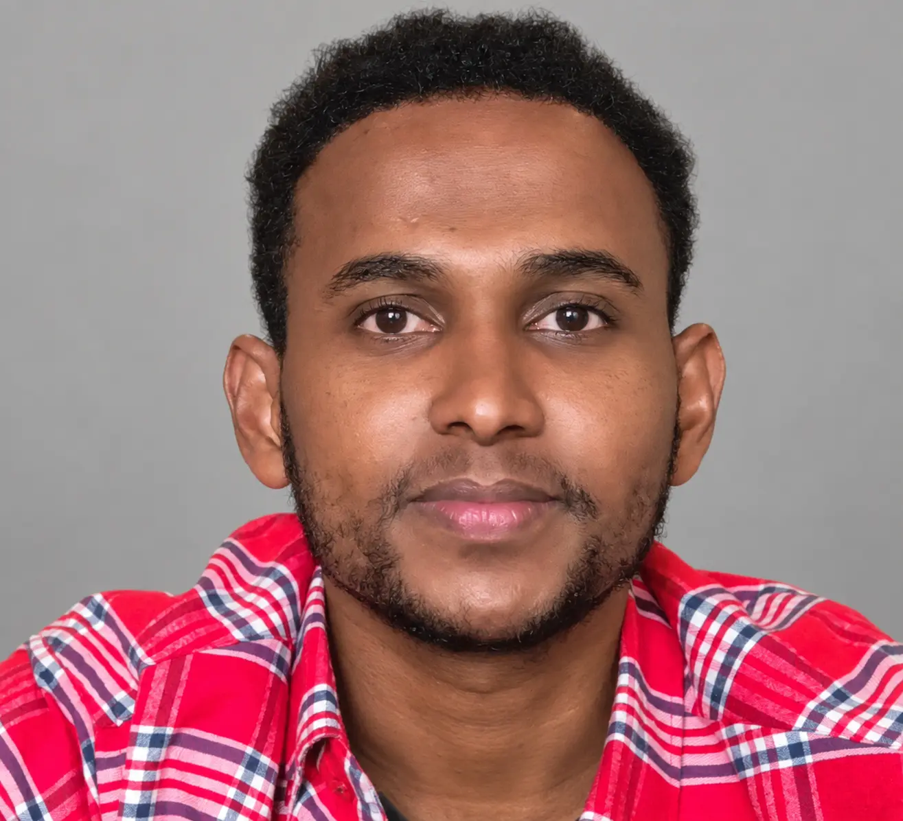 Sheriff after his Nairobi hair transplant with improved frontal hairline