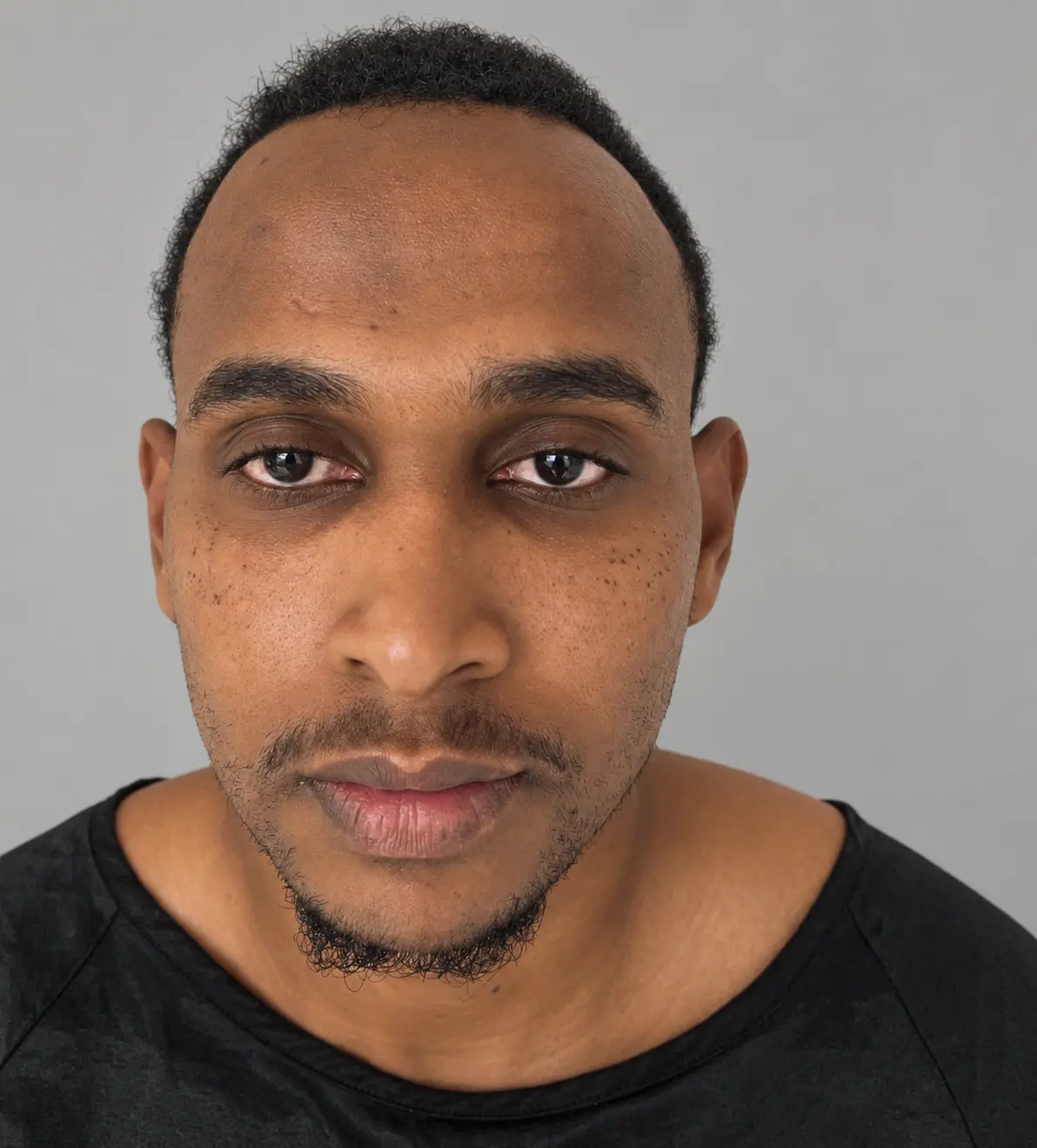 Sheriff before his Nairobi hair transplant with frontal hairline recession