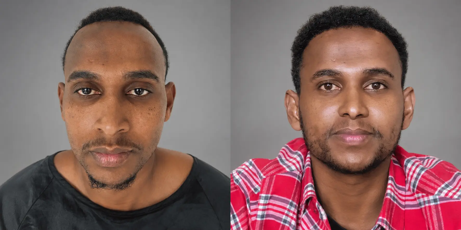 Sheriff before and after his hair transplant result in Nairobi