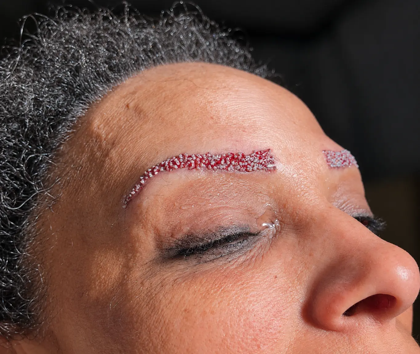 Close view of carefully placed eyebrow grafts immediately after transplantation