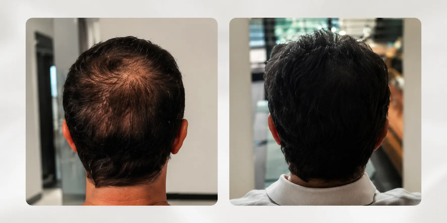Real client hair density photographs reviewed during a PRP treatment plan