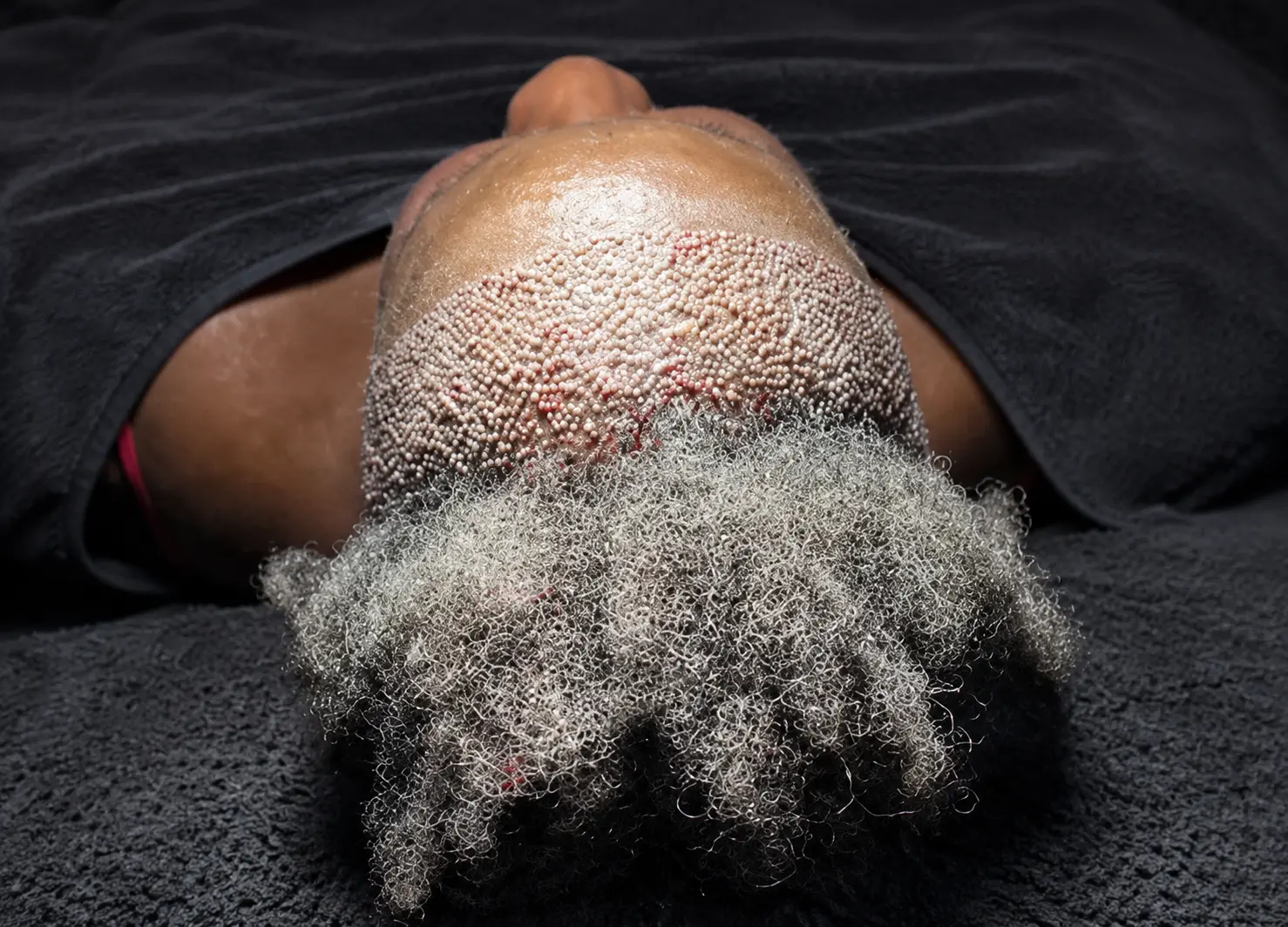 Real recipient area immediately after carefully placed hair grafts