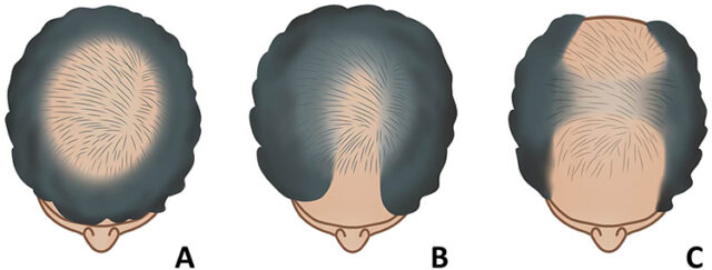 women hair loss pattern