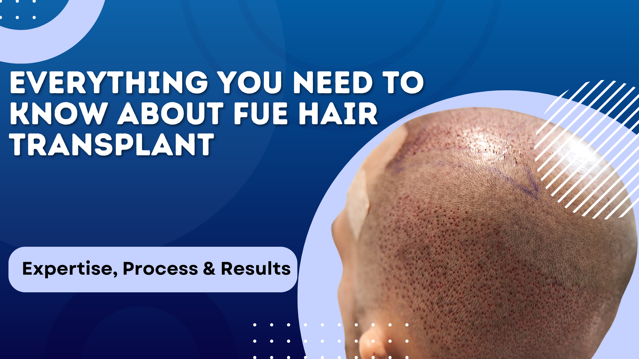 FUE Hair Transplant