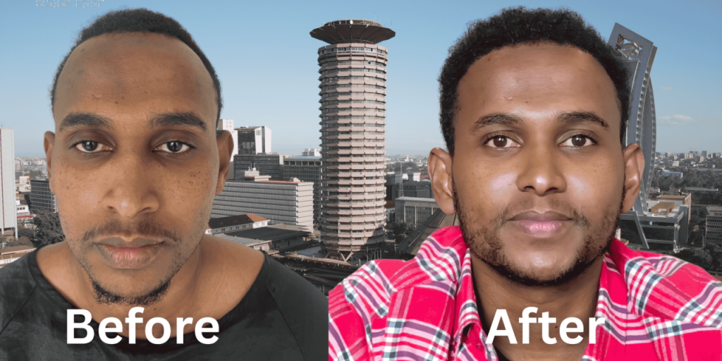 Before and After Hair Transplant