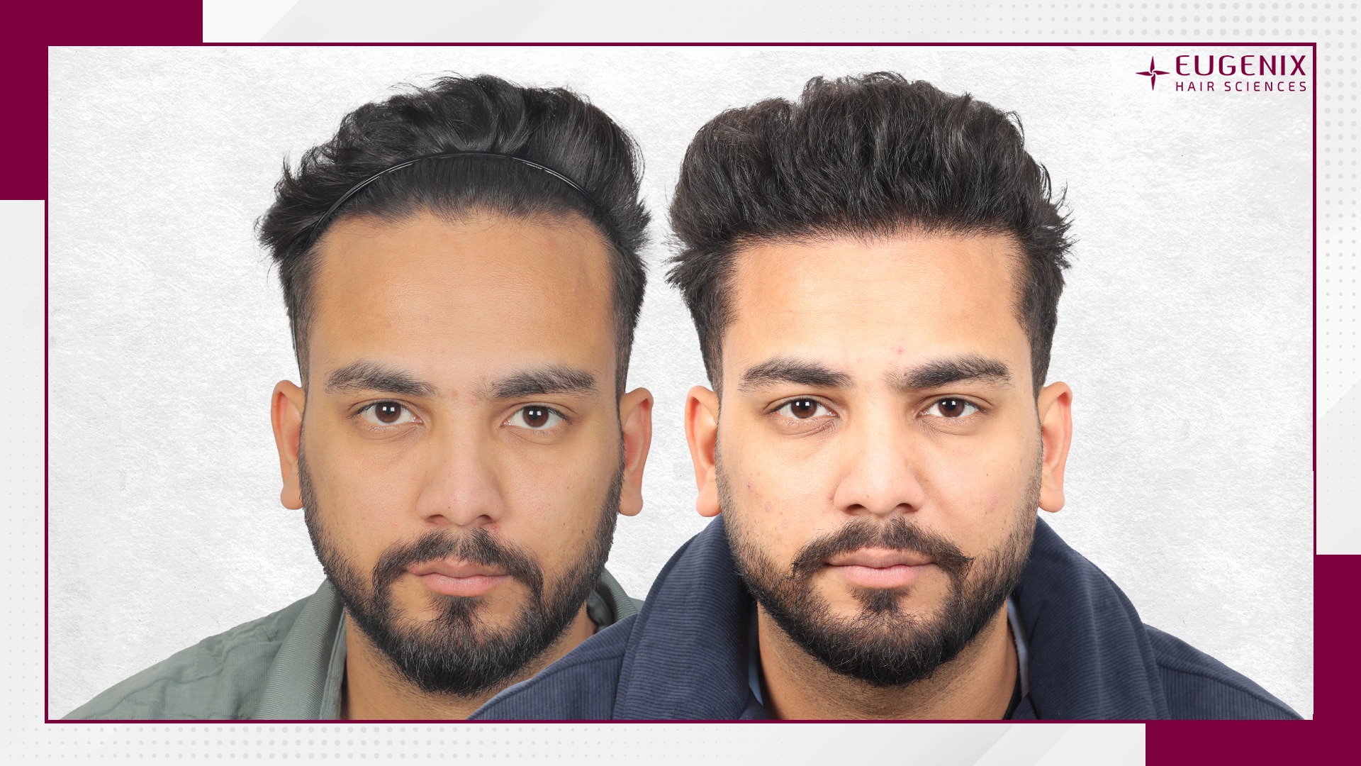 Elvish-Yadav-Hair-Transplant-Before-and-After-Results