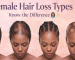 Female Hair Loss Types
