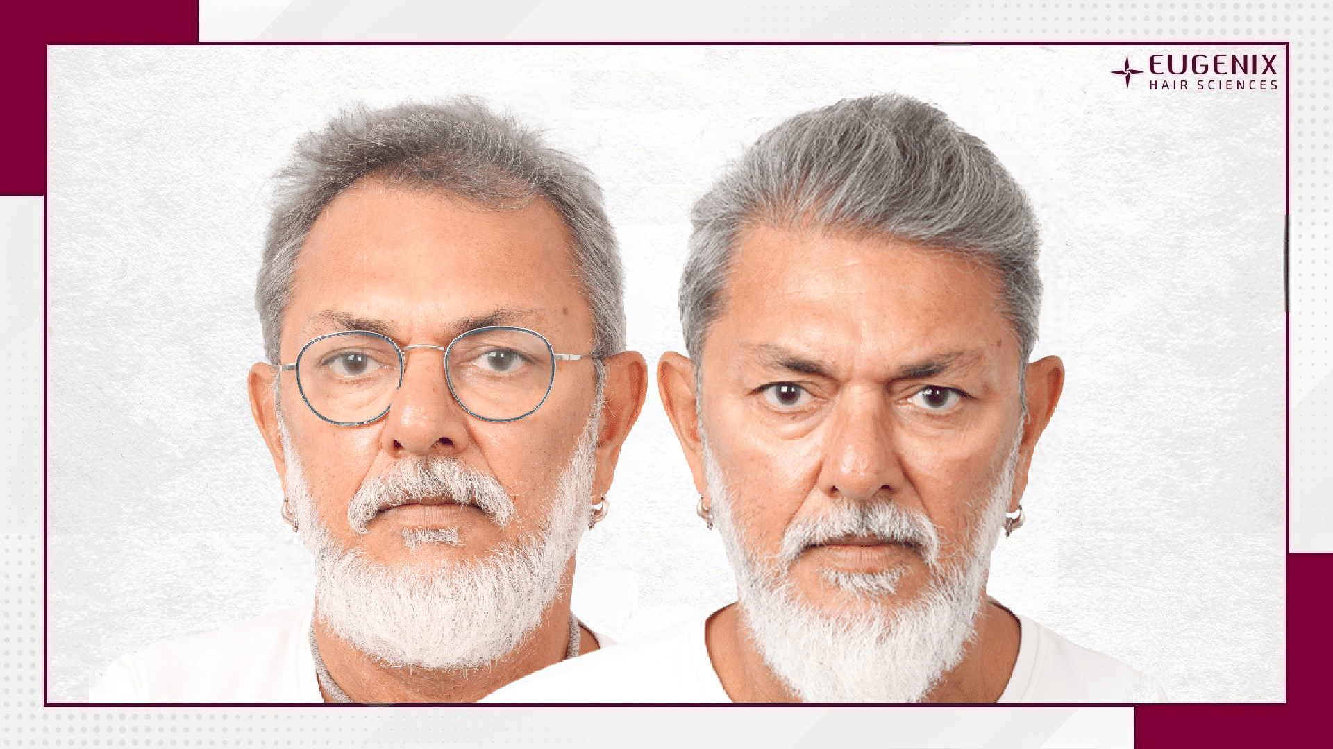 Rakeysh-Omprakash-Mehra-Hair-Transplant-1