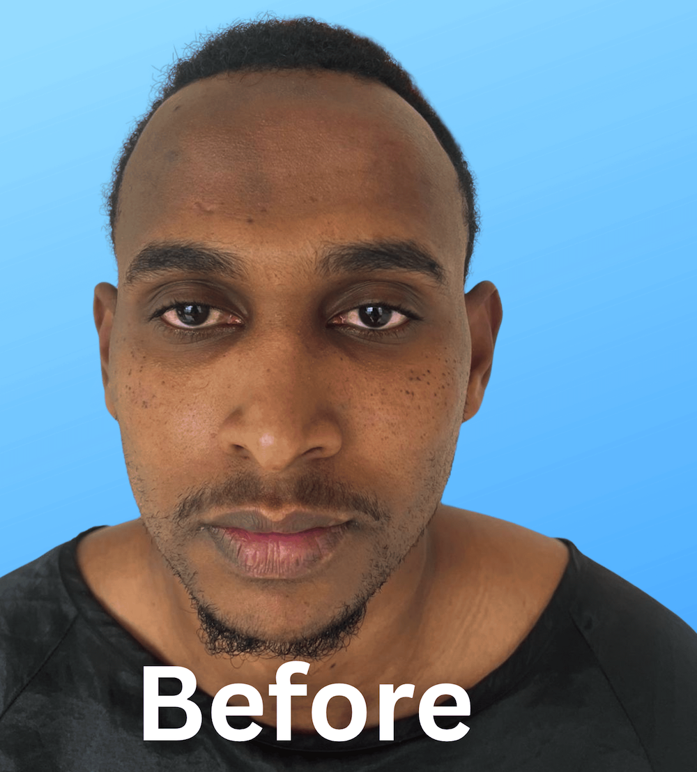 Before Hair Transplant – Receding Hairline