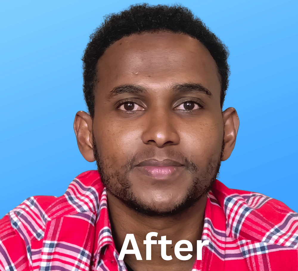After Hair Transplant – Natural Hairline Result