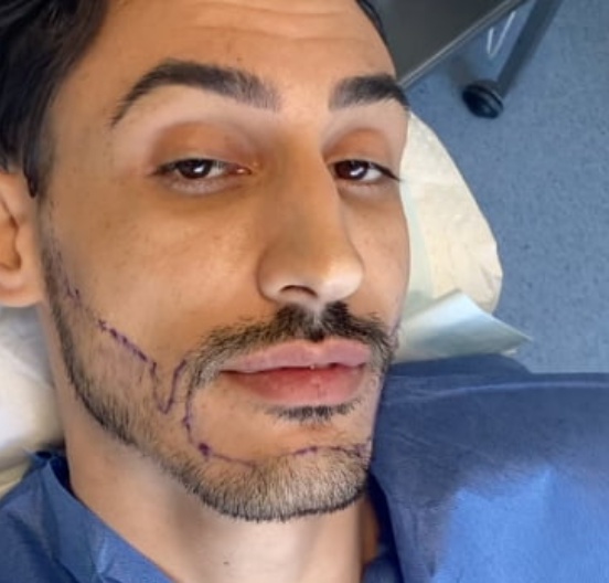 Beard transplant before and after Nairobi