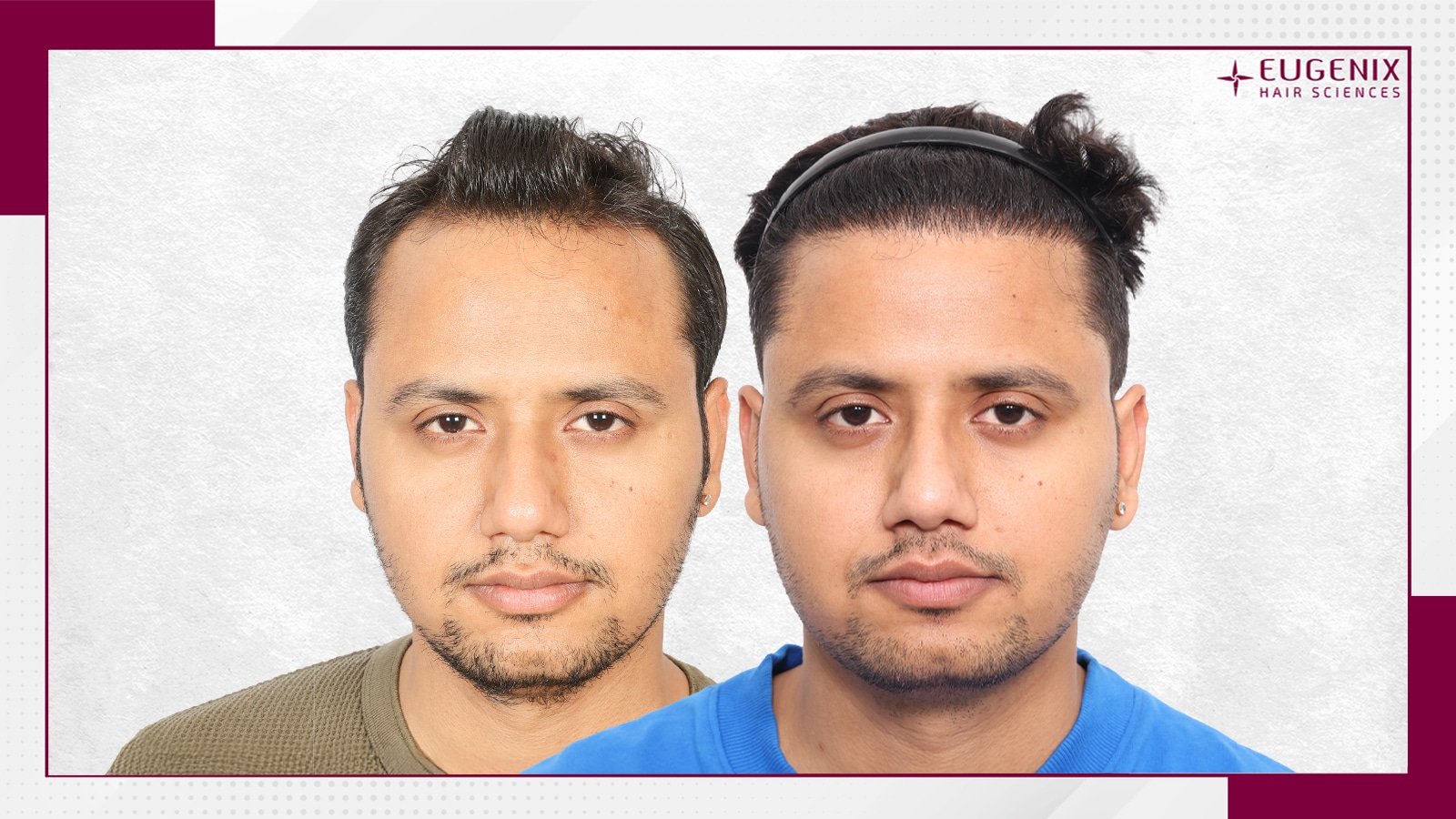 hair transplant clinic