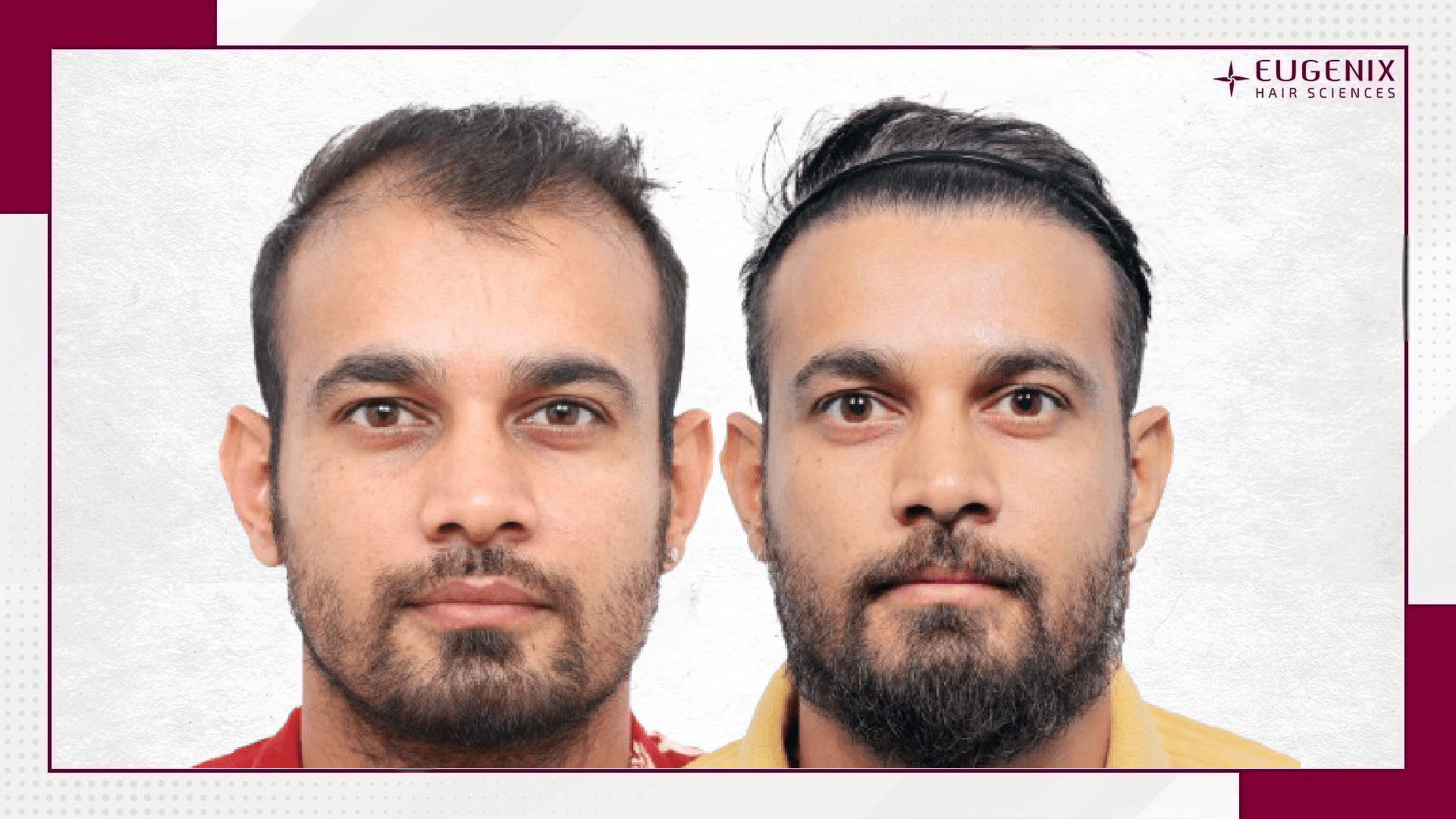 siddharth-kaul-hair-transplant-results